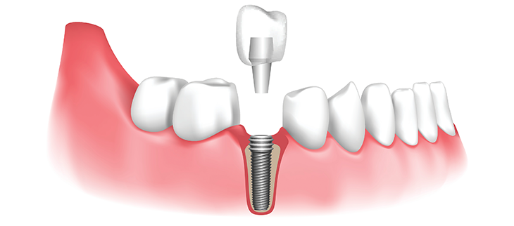 Diagram of a dental implant — titanium post, abutment, and porcelain crown — placed in the jawbone