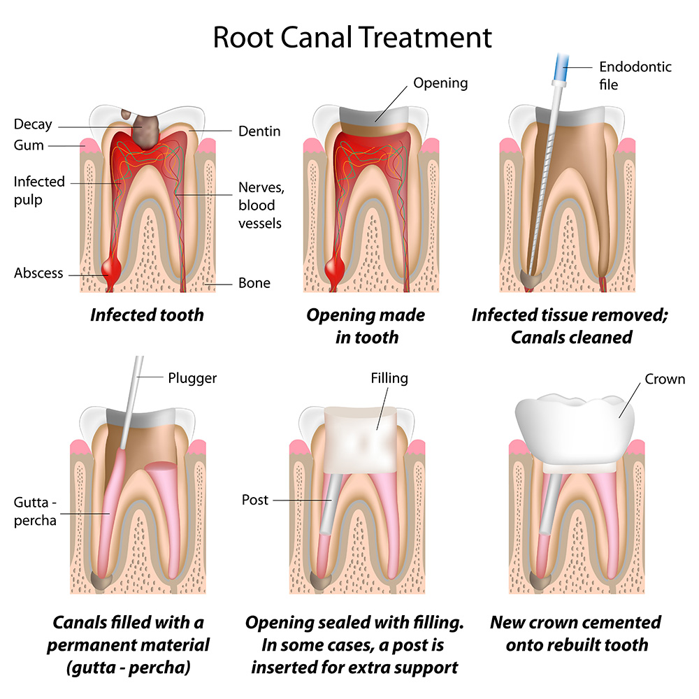 Root-Canal-Therapy