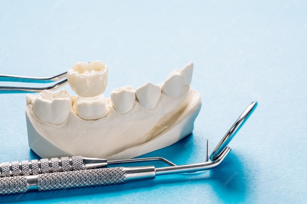 dental-bridges-in-wilmington