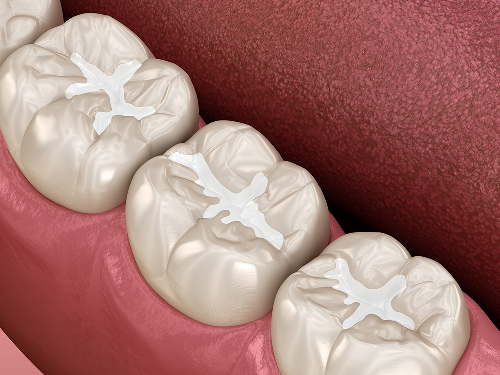 composite fillings in wilmington