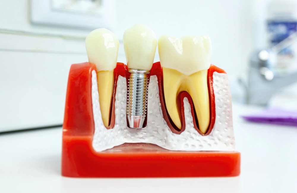 dental implants in wilmington