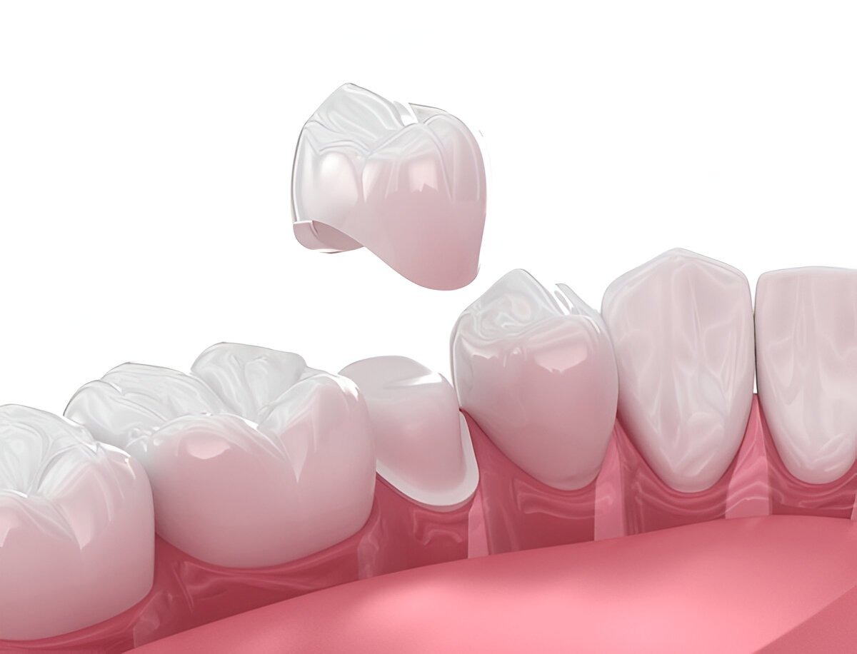 porcelain crowns near you