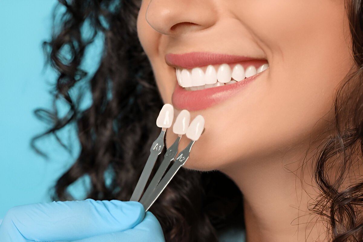 dental veneers in wilmington, de