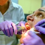 Tooth Extractions